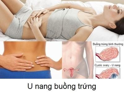 Cach dieu tri u nang buong trung khong can thuoc-Hinh-6